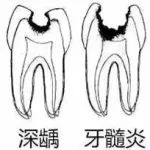 深龋与牙髓炎.jpg